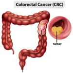 What are the 10 Early Signs of Colon Cancer?