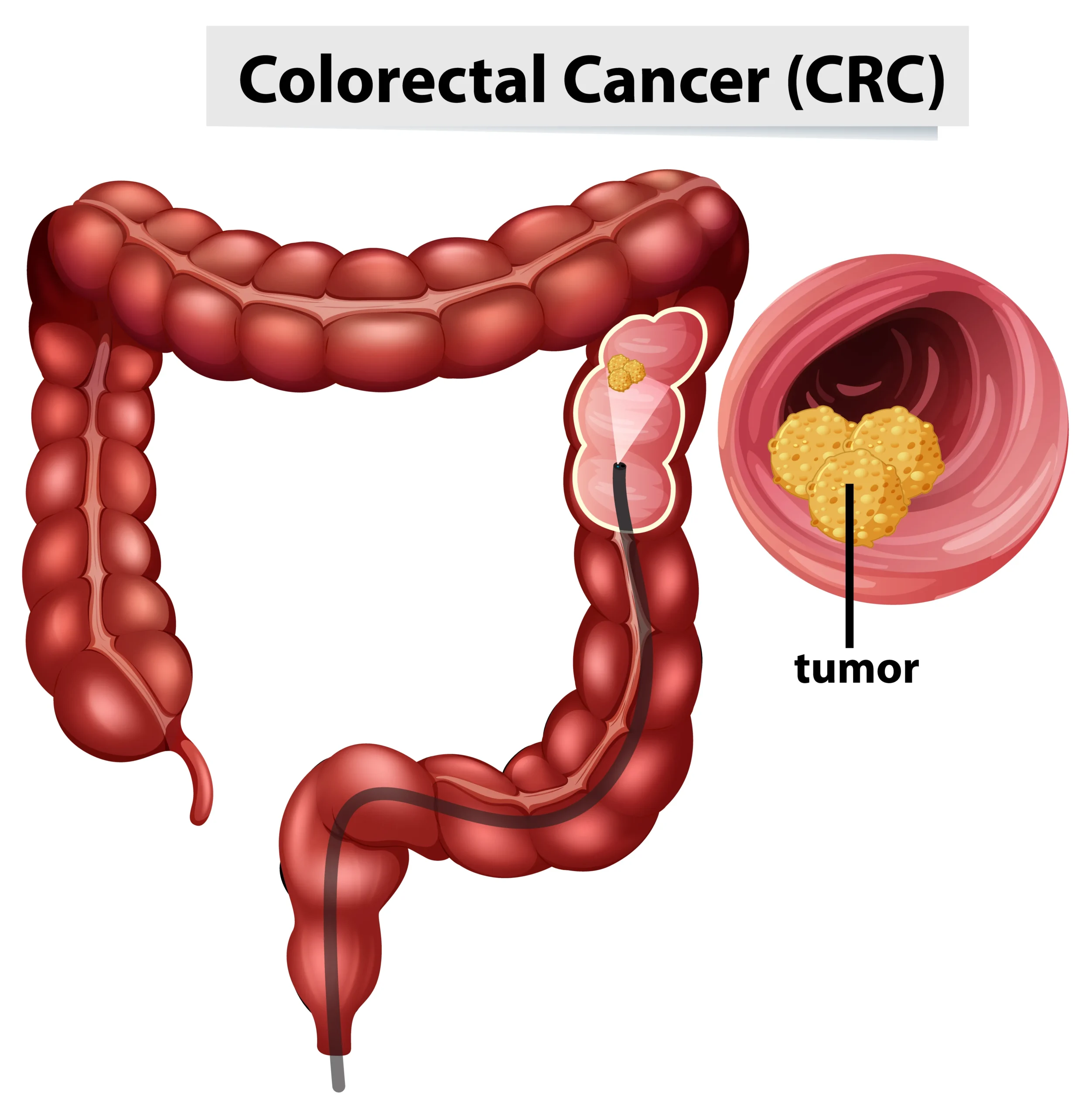 What are the 10 Early Signs of Colon Cancer?