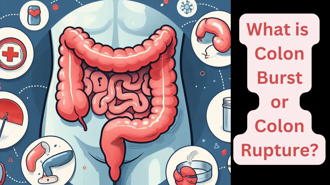 What is Colon Burst or Colon Rupture?