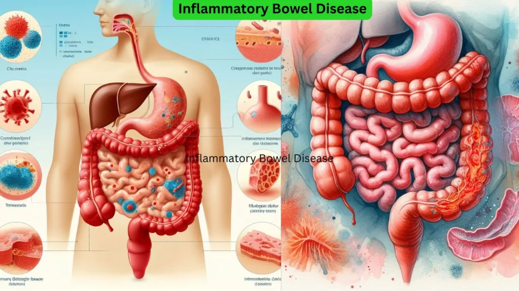 Inflammatory Bowel Disease image2